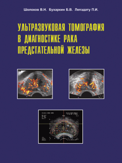 Ультразвуковая томография в диагностике рака предстательной железы